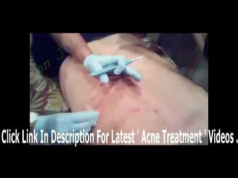 acne treatment at home 2017   Biggest Zit Cyst Pop Ever Best   squeeze acne horror