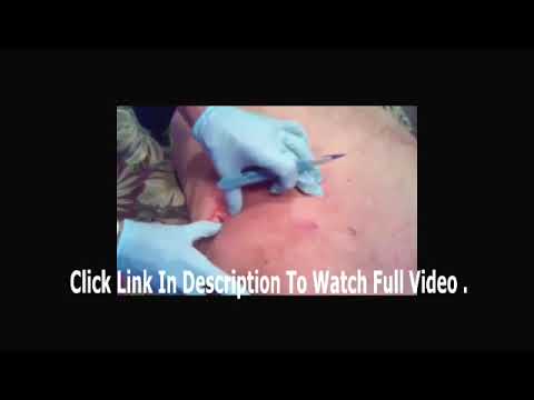 acne treatment at home 2017   Biggest Zit Cyst Pop Ever Best   squeeze acne horror