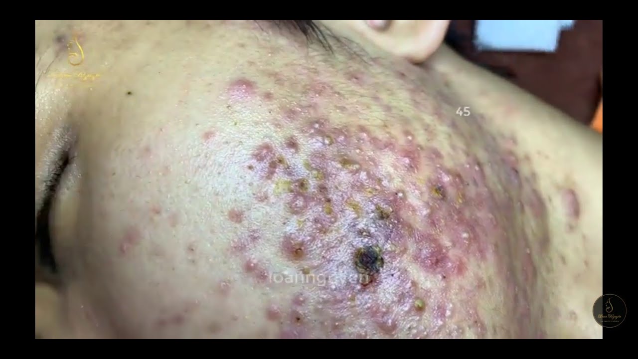 ACNE TREATMENT FOR Mạnh past 2 (45) | Loan Nguyen
