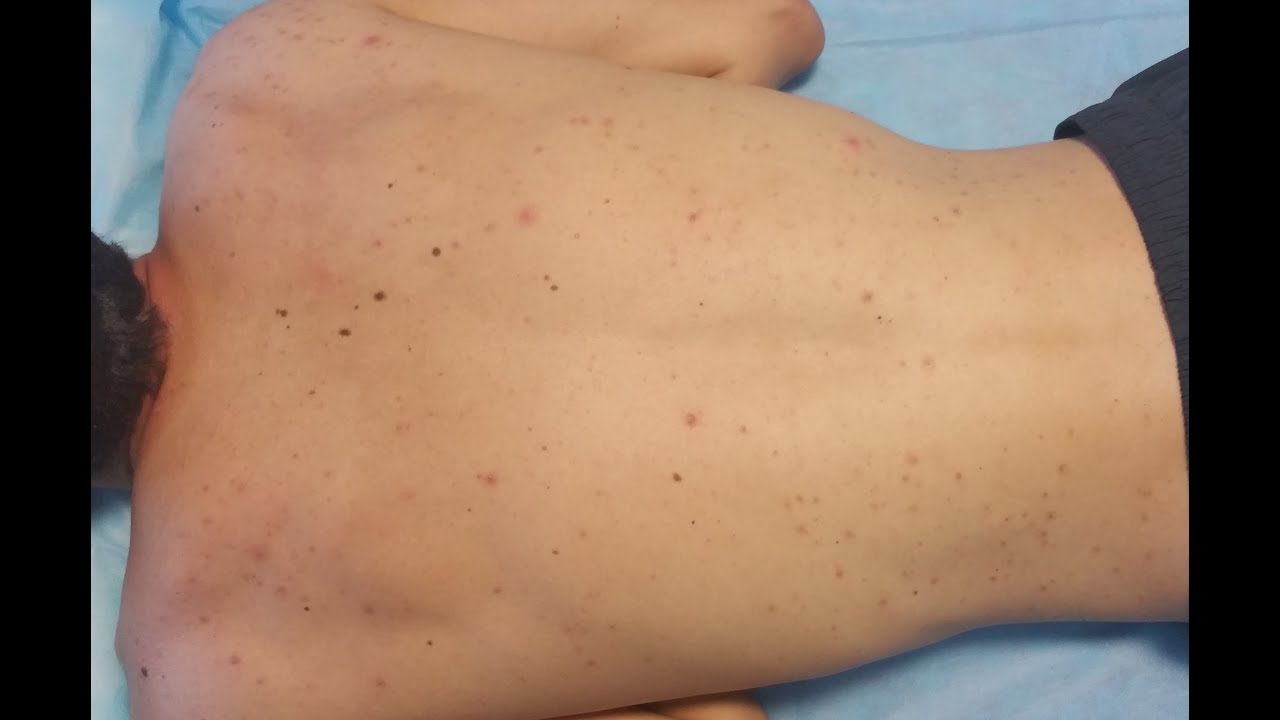 Acne Treatment on the Back (Infected Lesions)