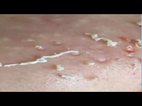 Acne Treatment – Pimple Popping 2020 (Part 5)