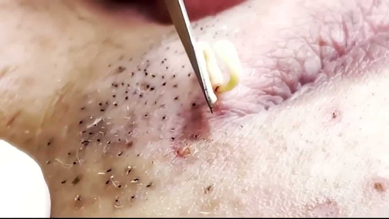 ACNE TREATMENT with LuLu / Relax BIG Pimple Popping, blackheads Removal videos 2021 #3