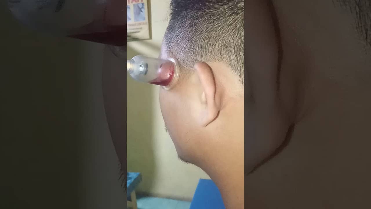 acne treatment,facial cupping, cyst extraction, pimple popping, jerawat batu,Cupping therapy