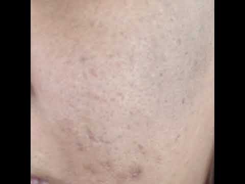 Acne treatments & pimple popping