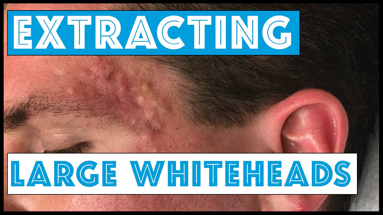 Acne Vulgaris and Extracting large Whiteheads – Part 1