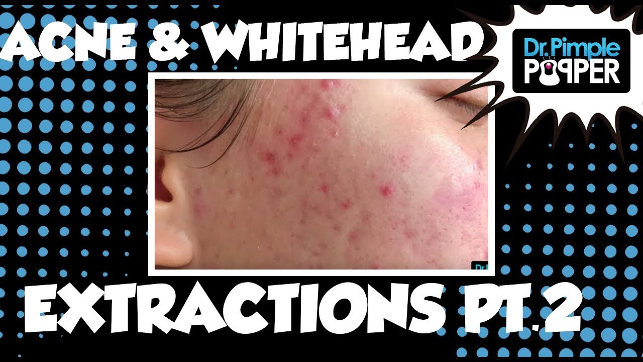 Acne & Whitehead Extractions – Session 2