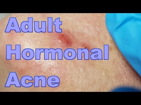 ADULT HORMONAL ACNE – Session #1
