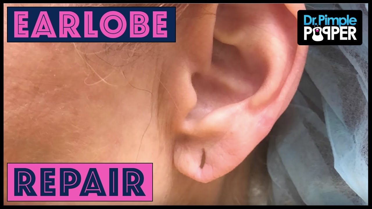 After Years of Heavy Earrings… Earlobe Repair