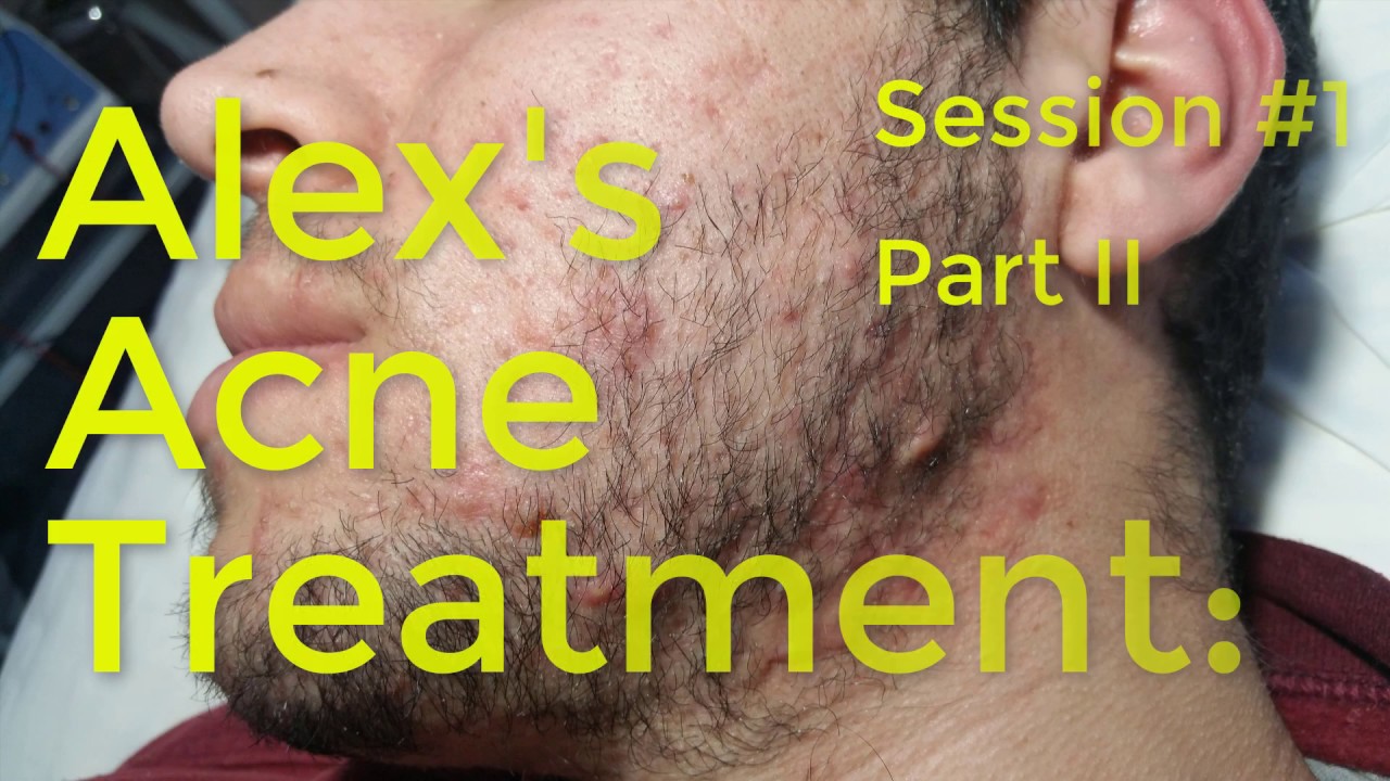 Alex’s Acne Treatment: Session #1 – Part 2 (of 2)