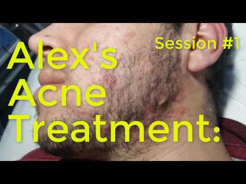 Alex’s Acne Treatment: Session#1