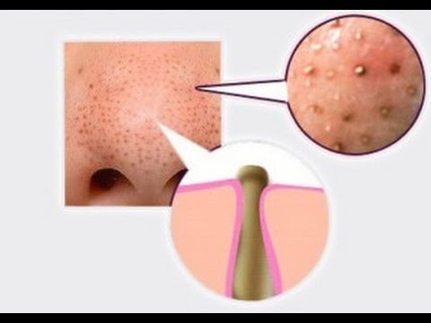 ALL ABOUT BLACKHEADS and DIY blackhead removal