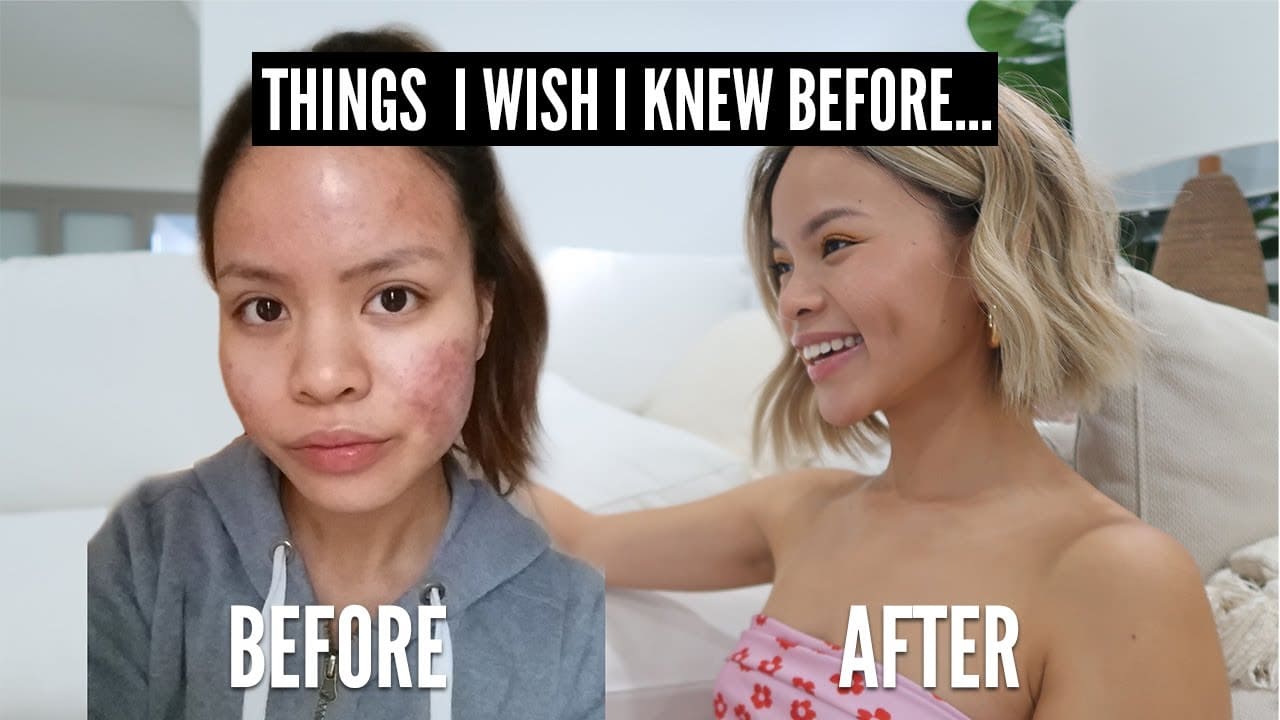 All The Things I Wish I Knew Before Acne