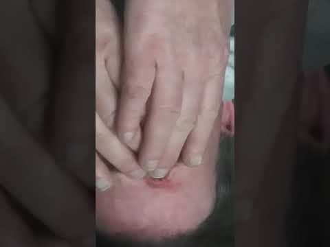 Alone Together…pandemic cyst popping has never been so fun!!