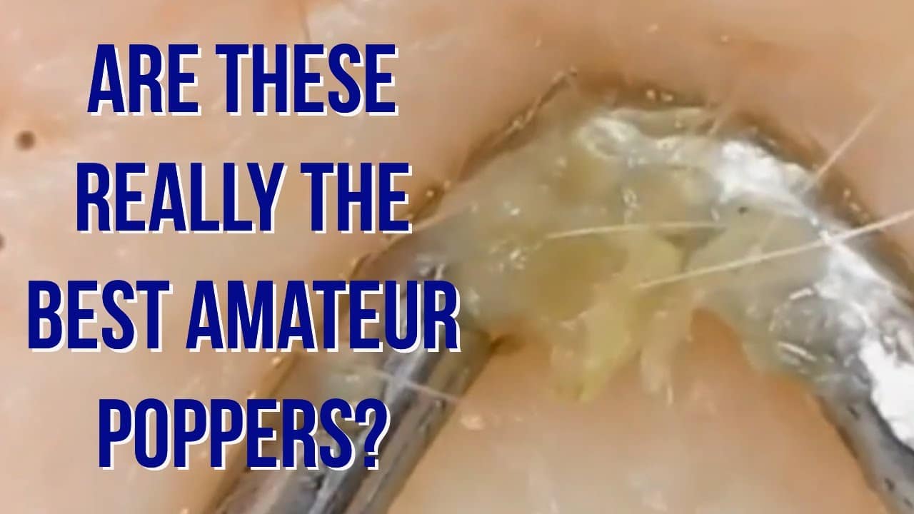 Amateur Poppers Show Off Their Pimple Popping Skills