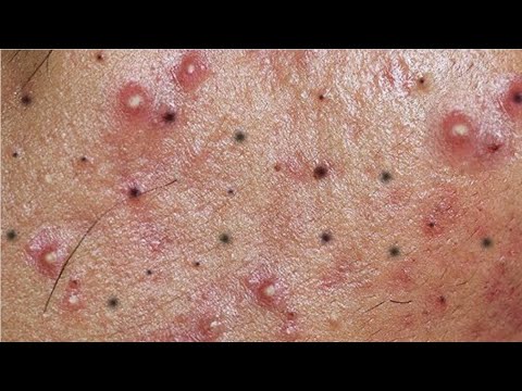 Amazing acne extraction – Pimple popping videos