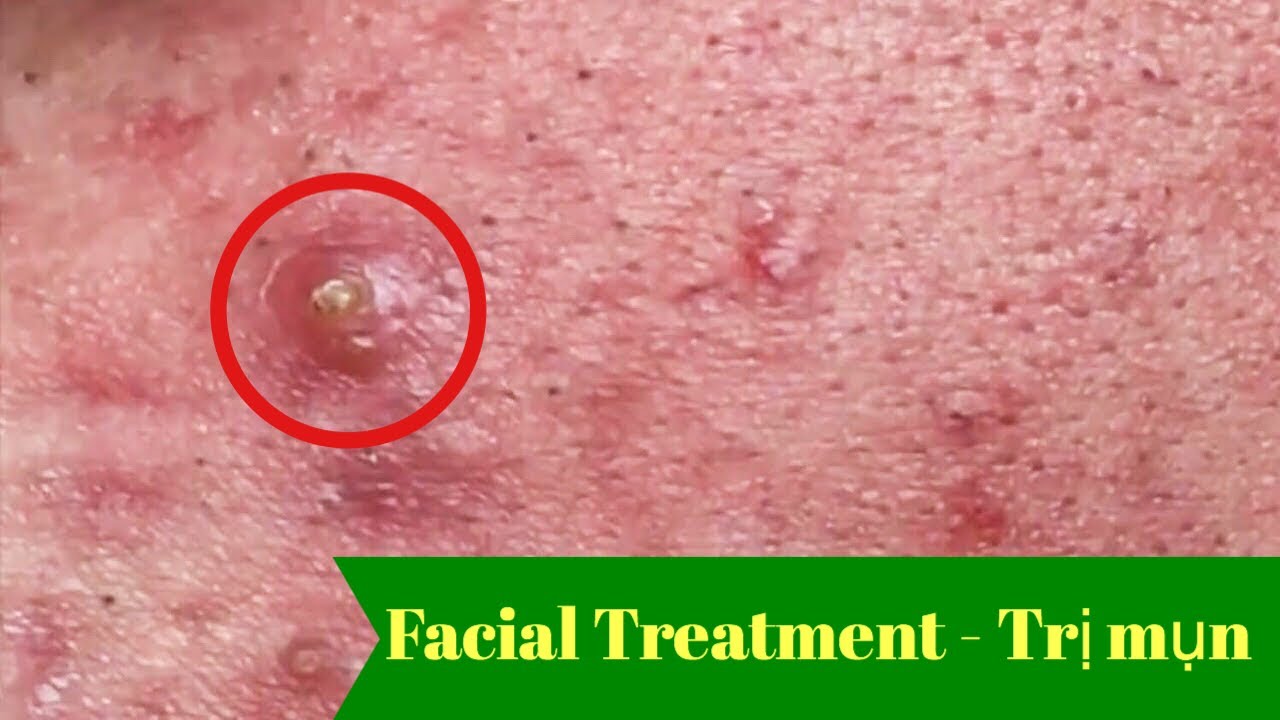 Amazing acne removal – Pimple popping videos