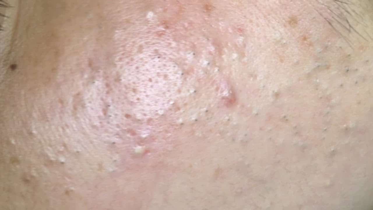 AMAZING BLACKHEADS AND ACNE POPPING | Full Popping [ 34 minutes ]
