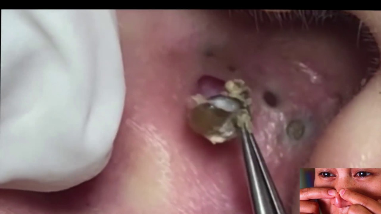 AMAZING Blackheads & Oozing Cysts Inside Ears Compilation!!
