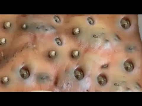 AMAZING BLACKHEADS REMOVAL | ACNE TREATMENT | PIMPLE POPPING