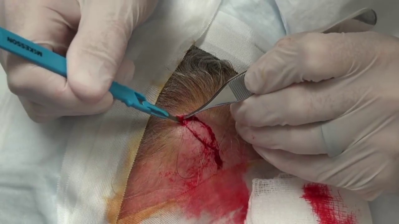 AMAZING CYSTS!  Stop and De-Cyst!