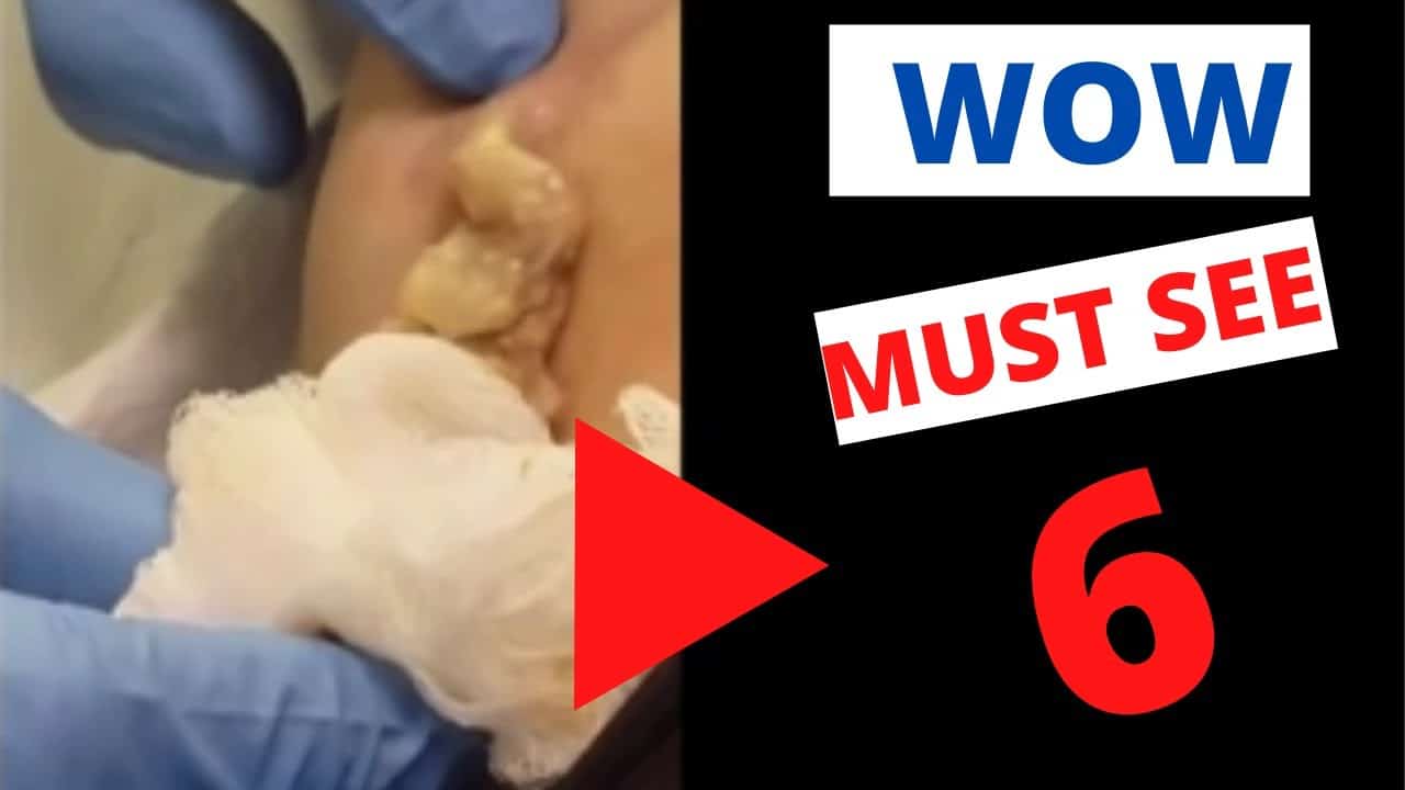 Amazing Pimple Popping, Boil Bursting, Cyst Lancing Compilation 6