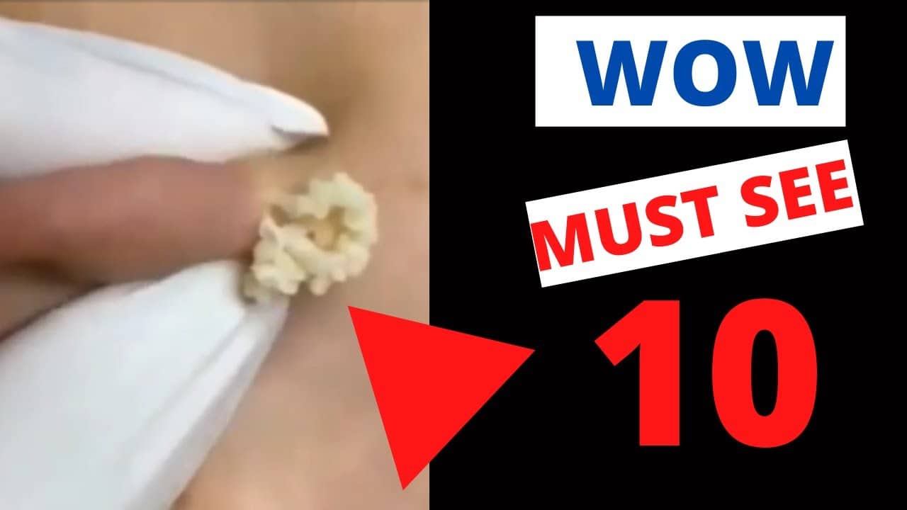 Amazing Pimple Popping, Boil Bursting, Cyst Lancing Compilation 10