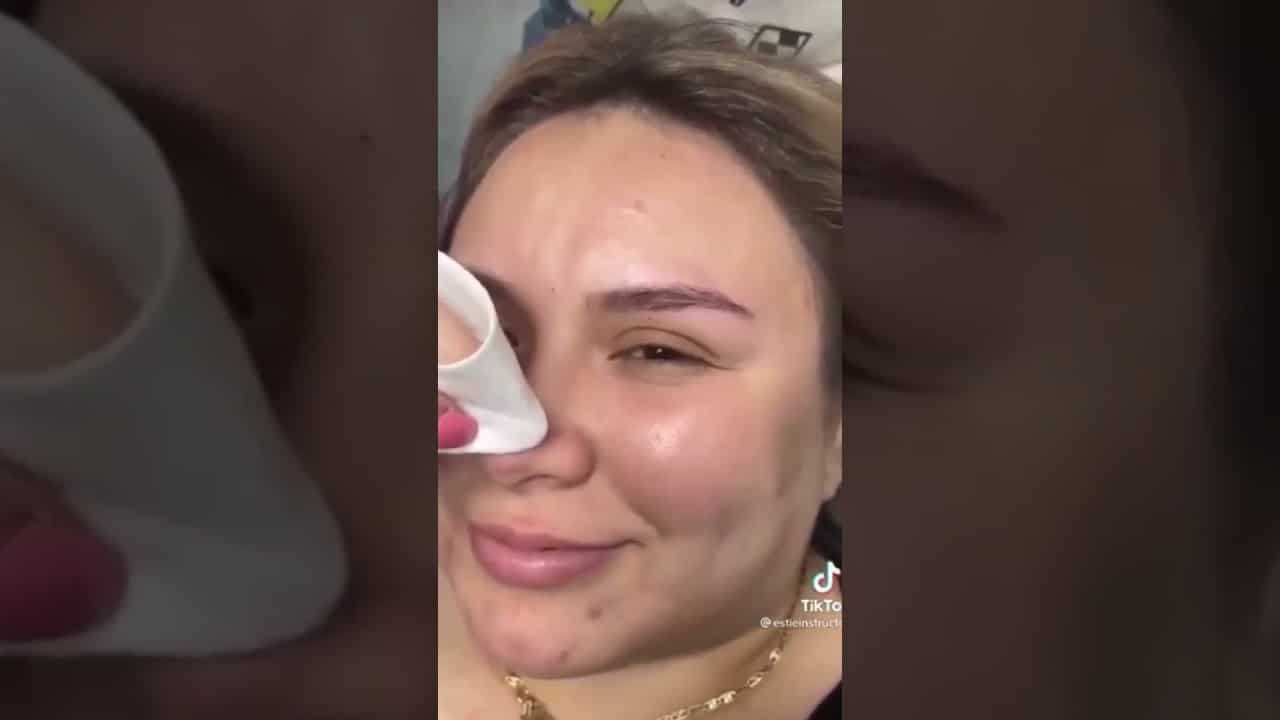 Amazing Popping huge blackheads and BEST Pimple Popping TIKTOK Videos Compilation #15