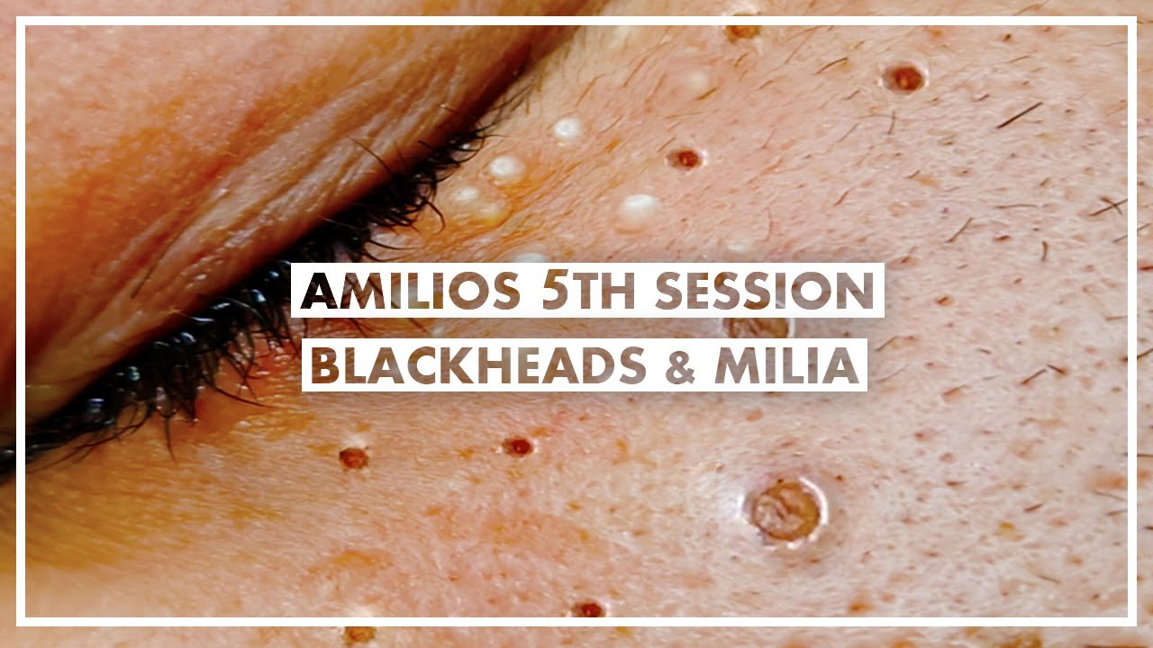 Amilios 5th Session – Blackheads And Milia Extraction On The Face