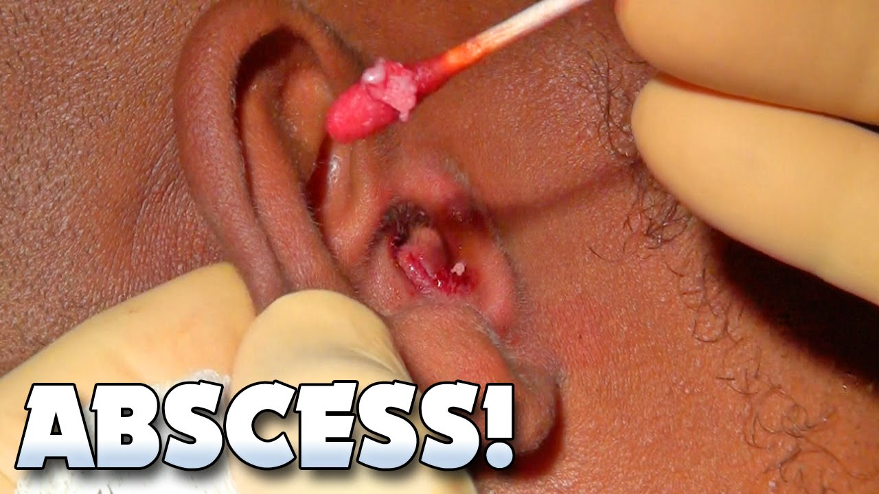 an abscess inside the ear?