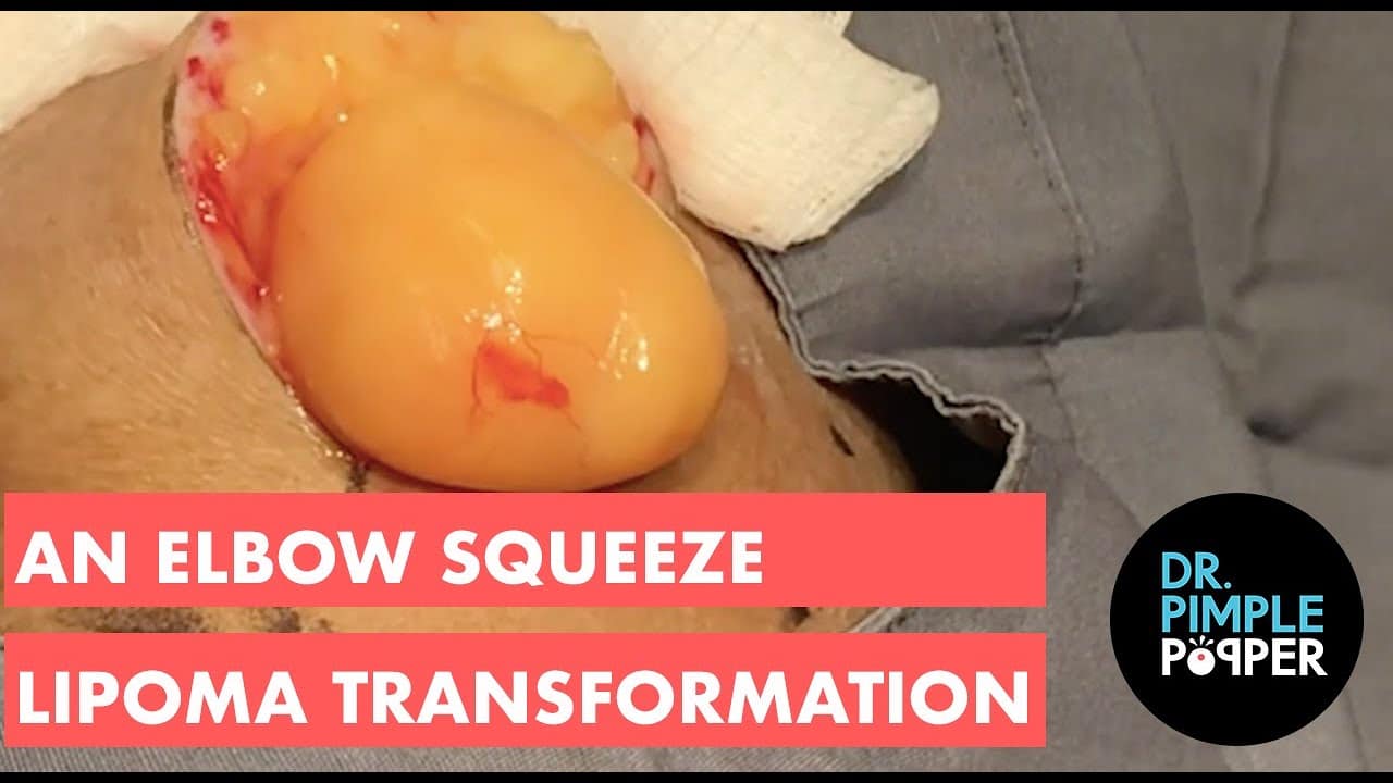 An Elbow Squeeze Lipoma Transformation!