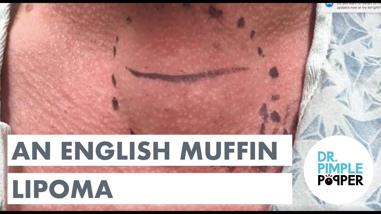 An English Muffin Lipoma