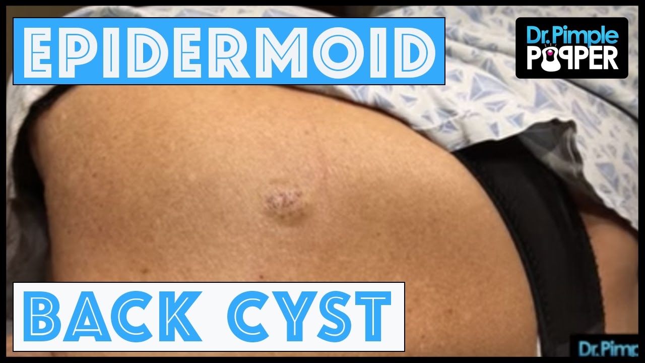 An Epidermoid Cyst: Let’s cure it with a curette!