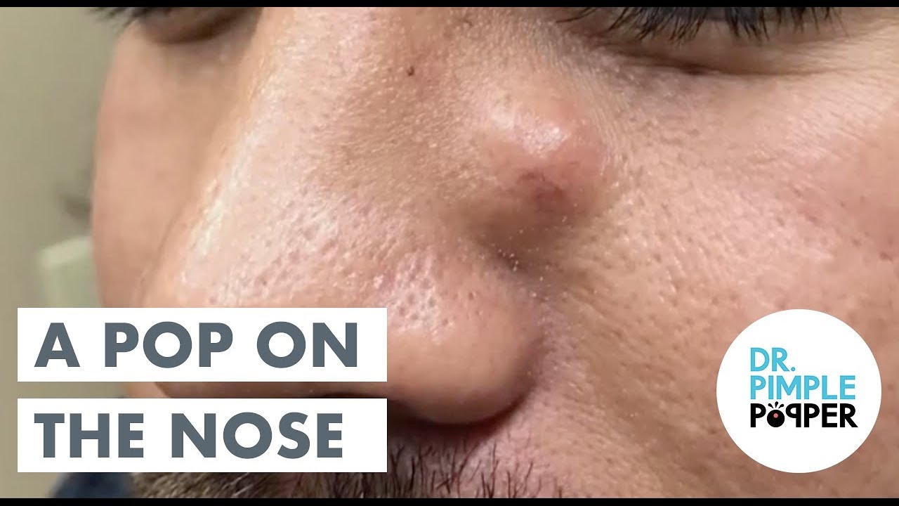An Excor-CYST-em… with Dr Pimple Popper