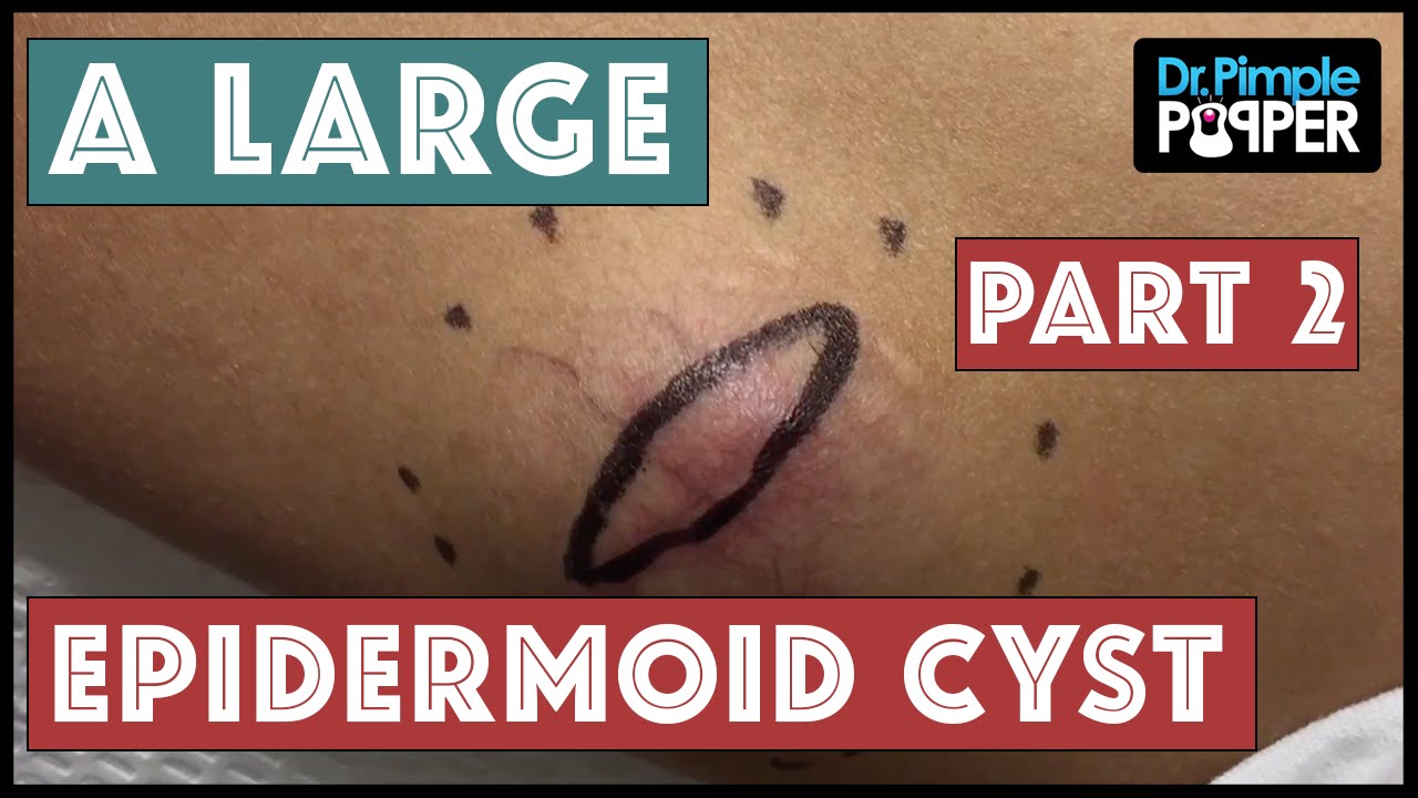 An Extra Elbow, a Floatation Device, or an Epidermoid Cyst? – Part 2 of 2