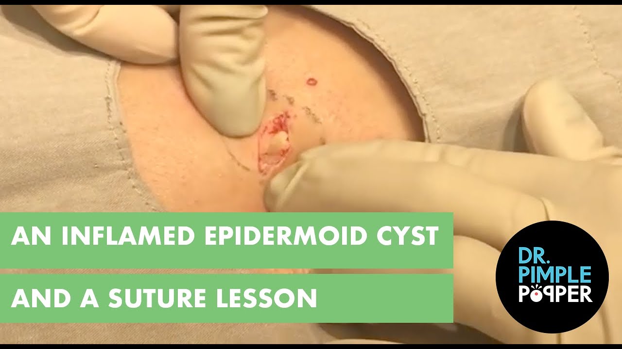 An Inflamed Cyst and A Suture Lesson