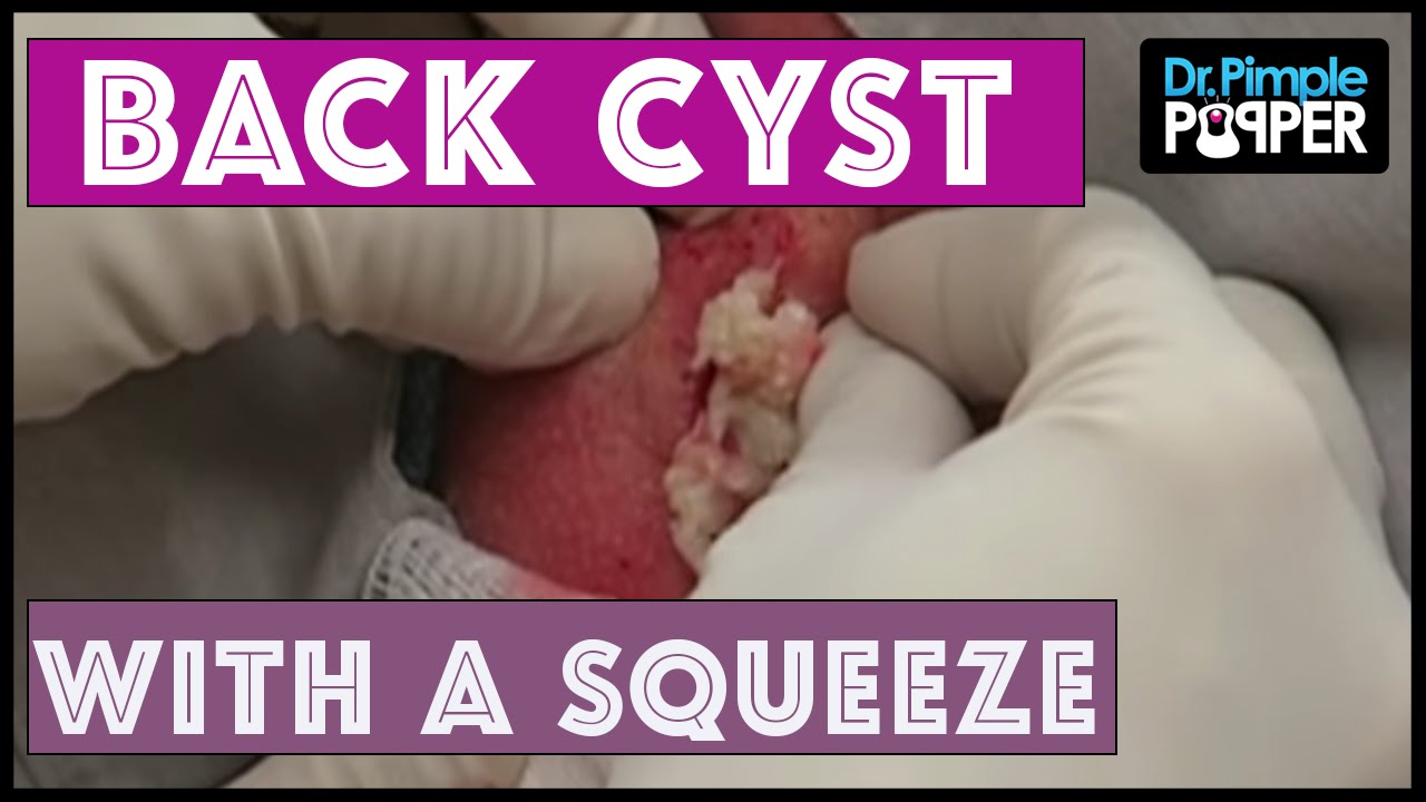 An initially nervous patient with a popaholic wife: Nice Cyst Squeeze & whiteheads!