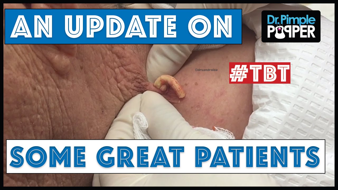 An Update On Some Great Patients – Dr. Pimple Popper