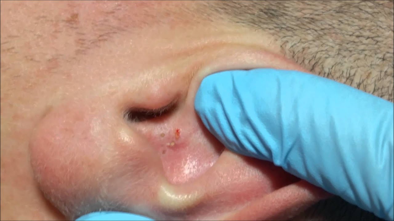 Ángel’s Acne Treatment:  Blackheads on the Ear