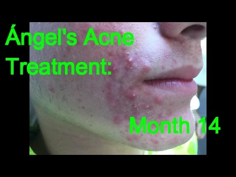 Ángel’s Acne Treatment: Month 14