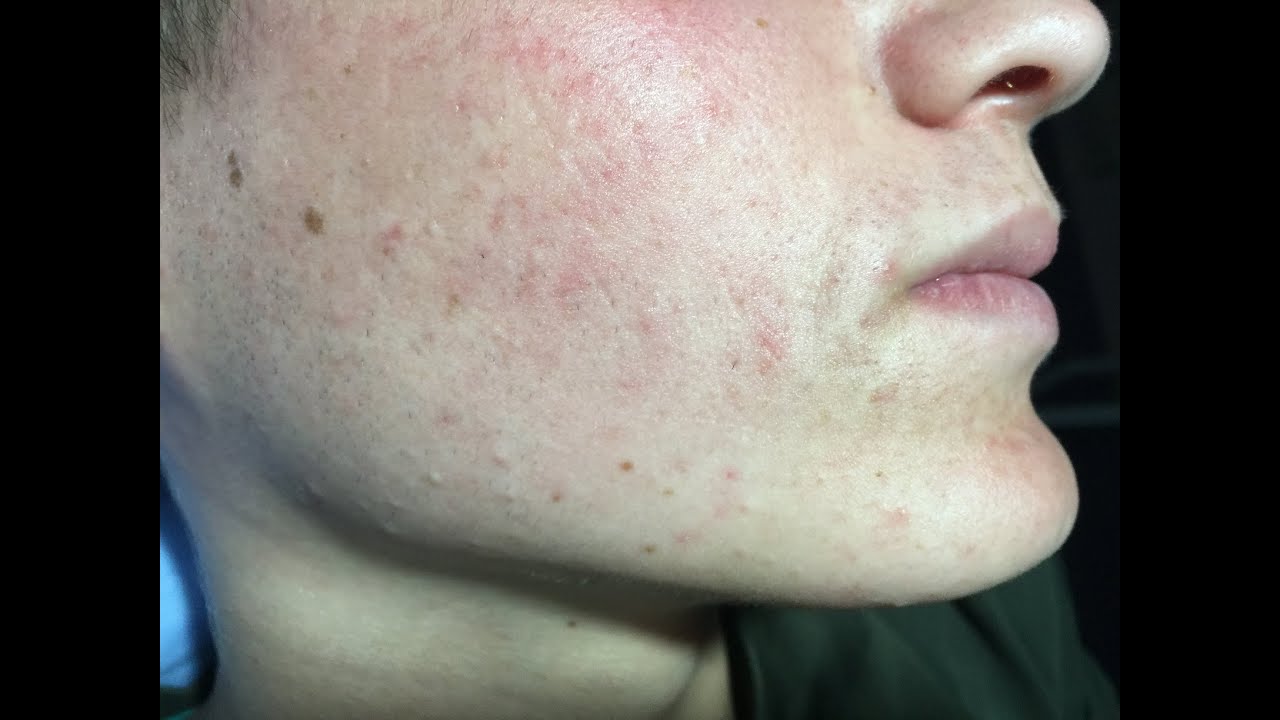 Ángel’s Acne Treatment:  Month 4