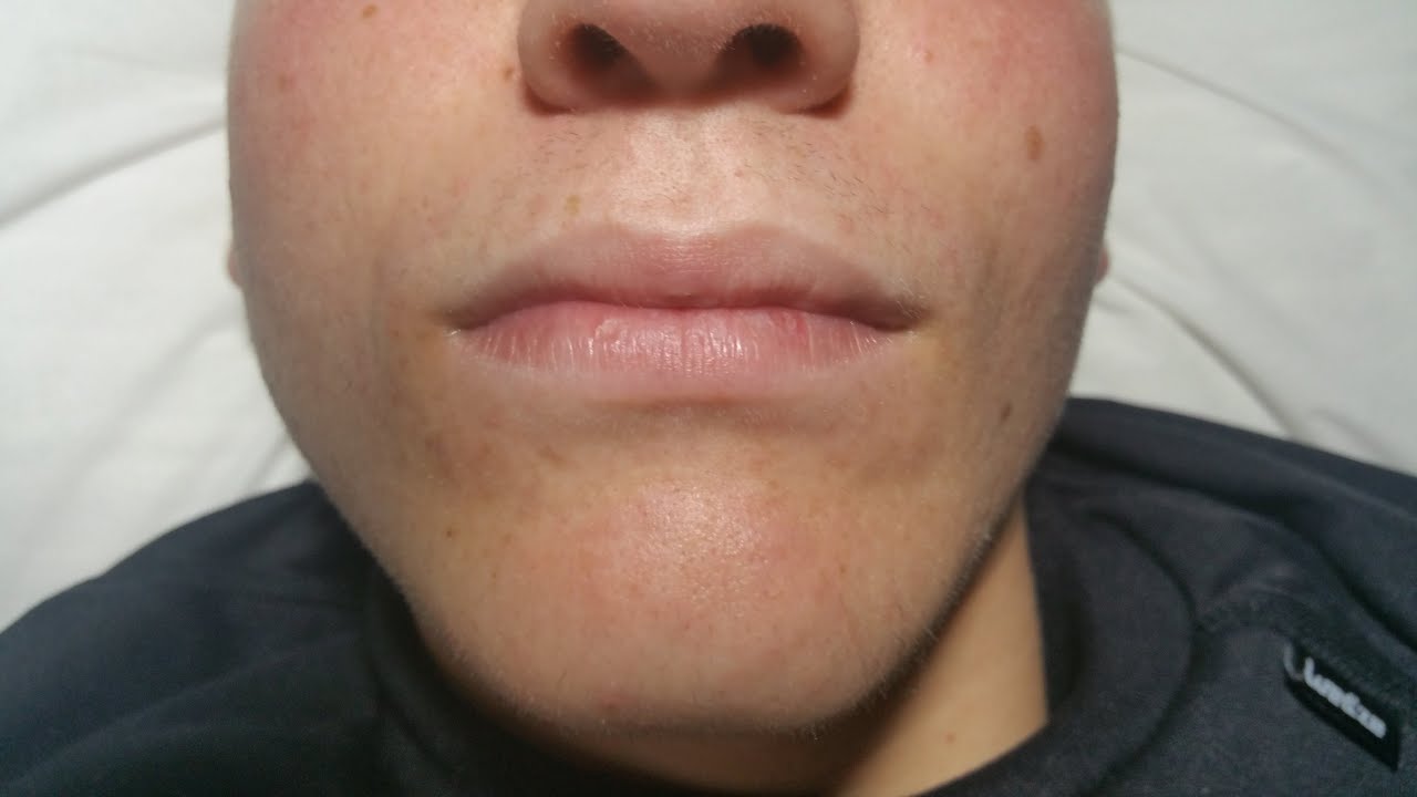 Ángel’s Acne Treatment:  Month 5