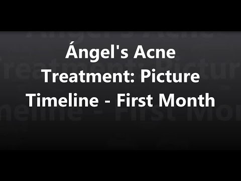 Ángel’s Acne Treatment:  Picture timeline – First Month