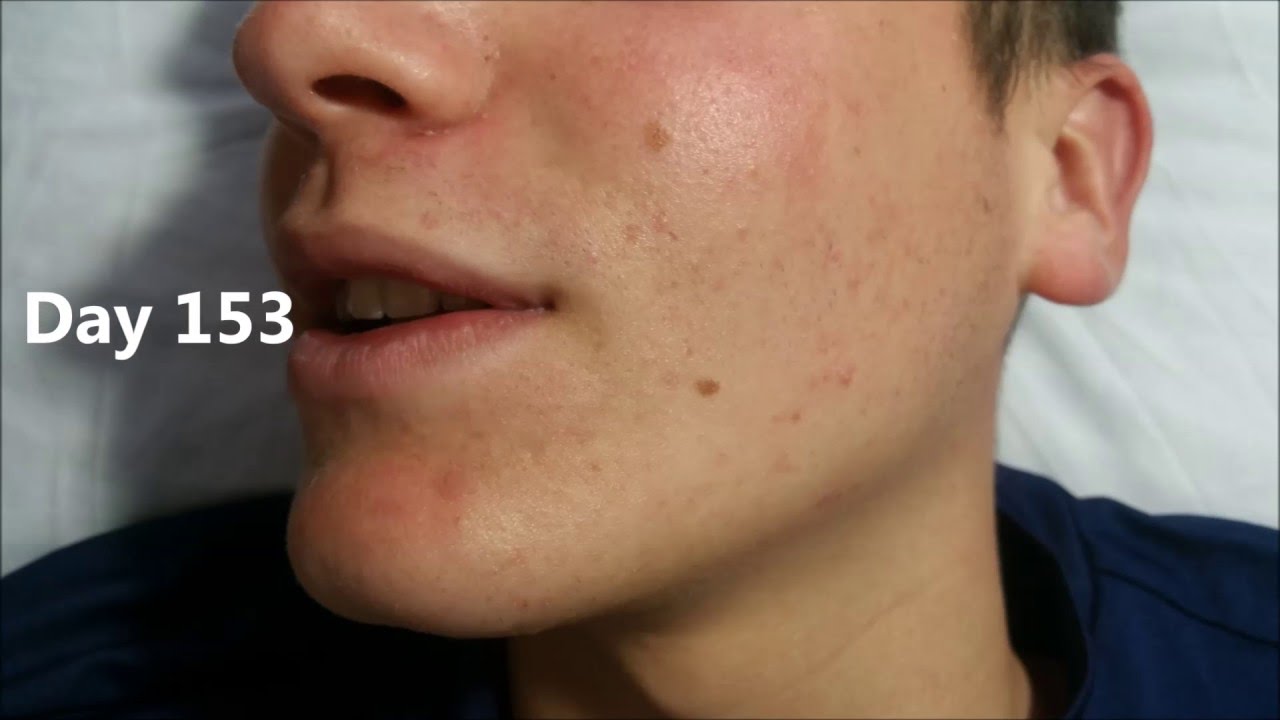 Ángel’s Acne  Treatment: Picture  Timeline – First Five  Months