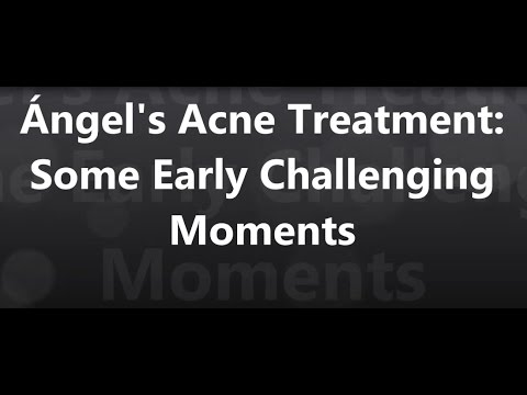 Ángel’s Acne Treatment – Some Early Challeging Moments – Session 3