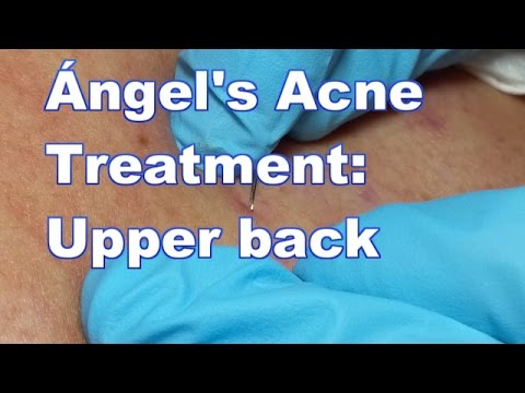 Ángel’s Acne Treatment:  Upper Back