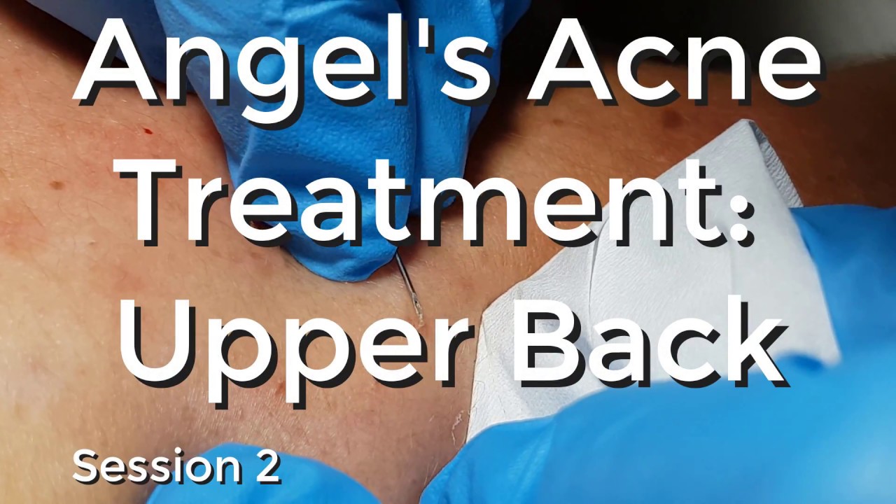 Angel’s Acne treatment  Upper Back – Session II