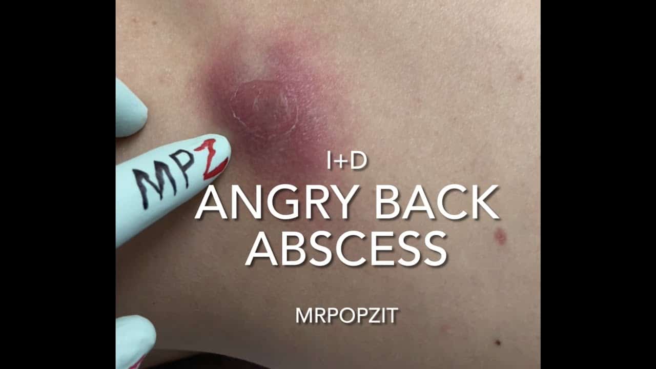 Angry back abscess popped and drained. Incision + Drainage with packing inserted. 24hr follow up.