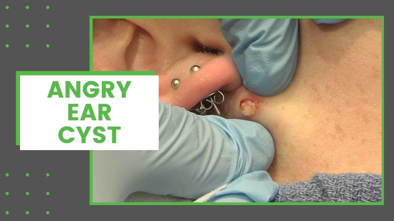 Angry Ear Cyst | Dr. Derm
