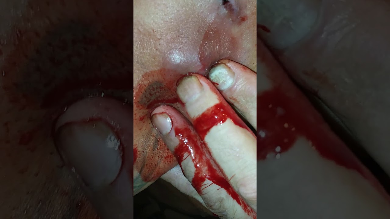 Another cyst