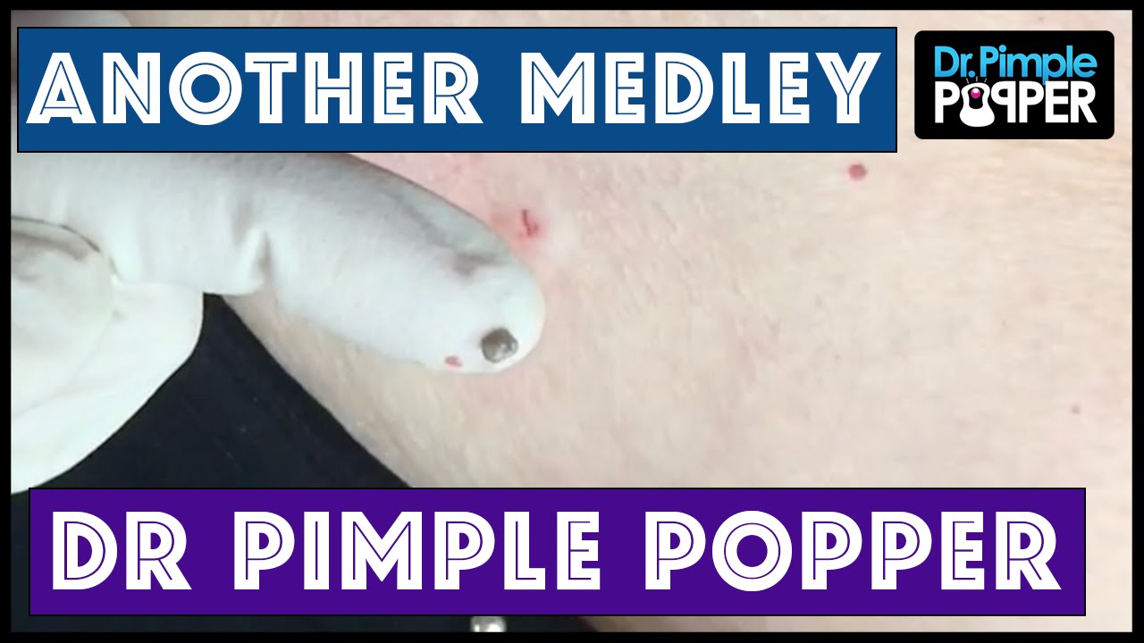 Another Medley with Dr. Pimple Popper